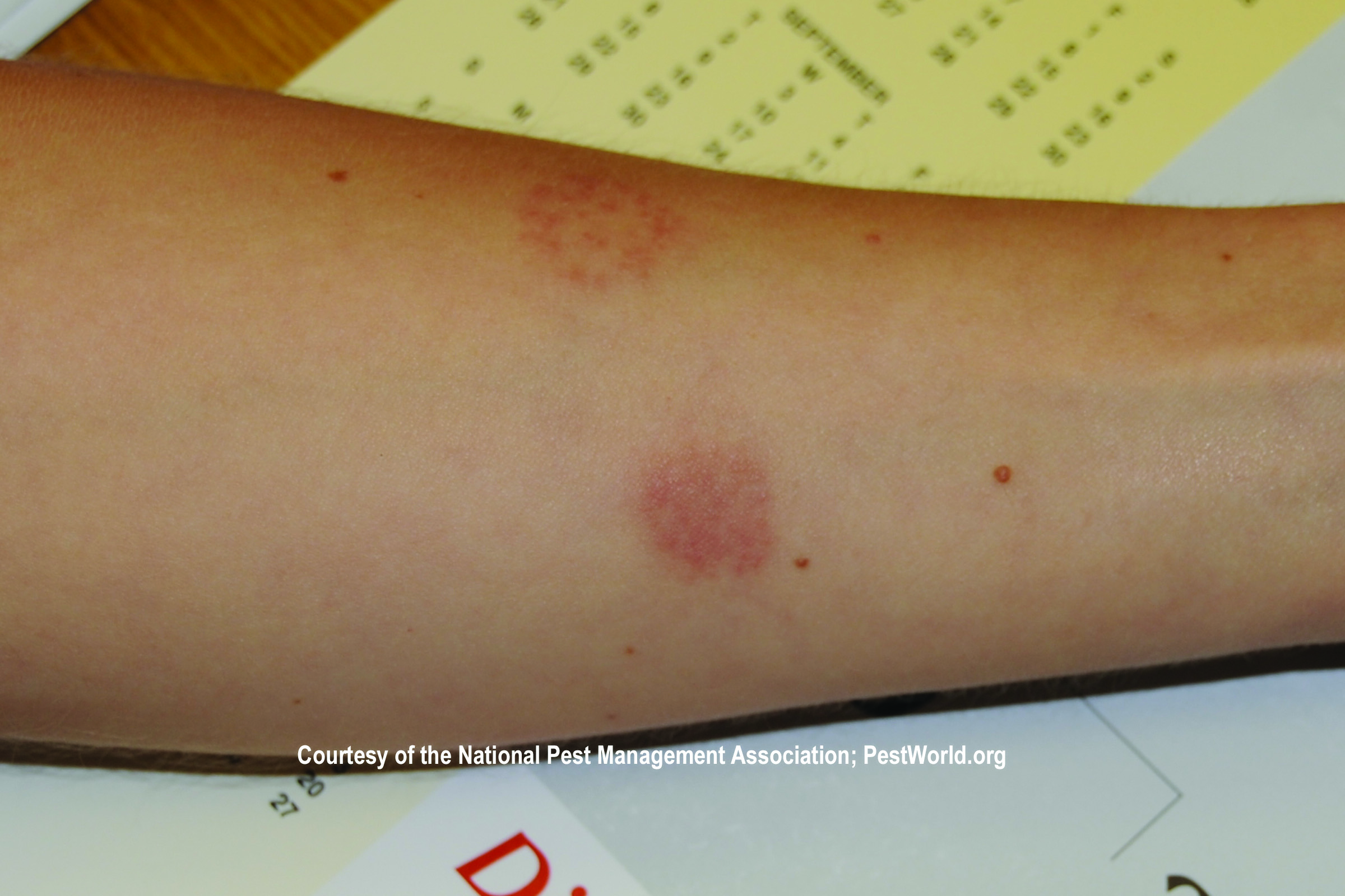 A rash on an arm caused by a bed bug