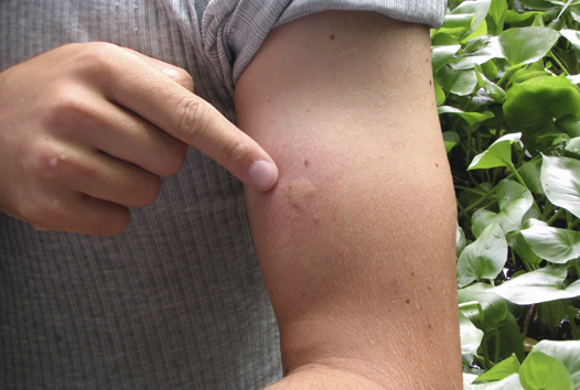 Mosquito bite on an arm