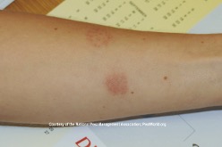 Bed bug bites on a person’s arm