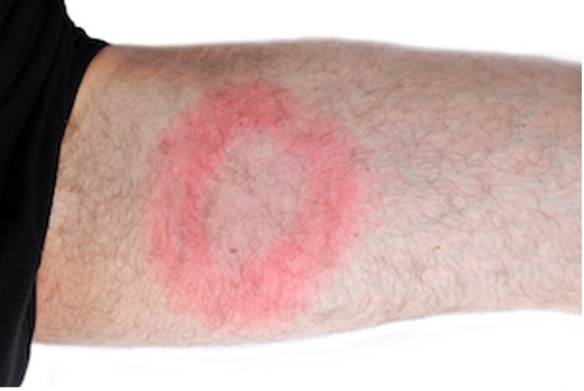 Tick Bite On A Person’S Arm